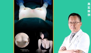 张敬德2026年脂肪胸案例01